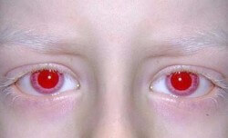 Albinos need not apply in the state of New York