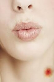 hickey