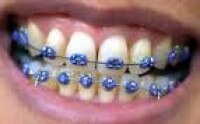 malia-obama-braces malia-obama-braces
